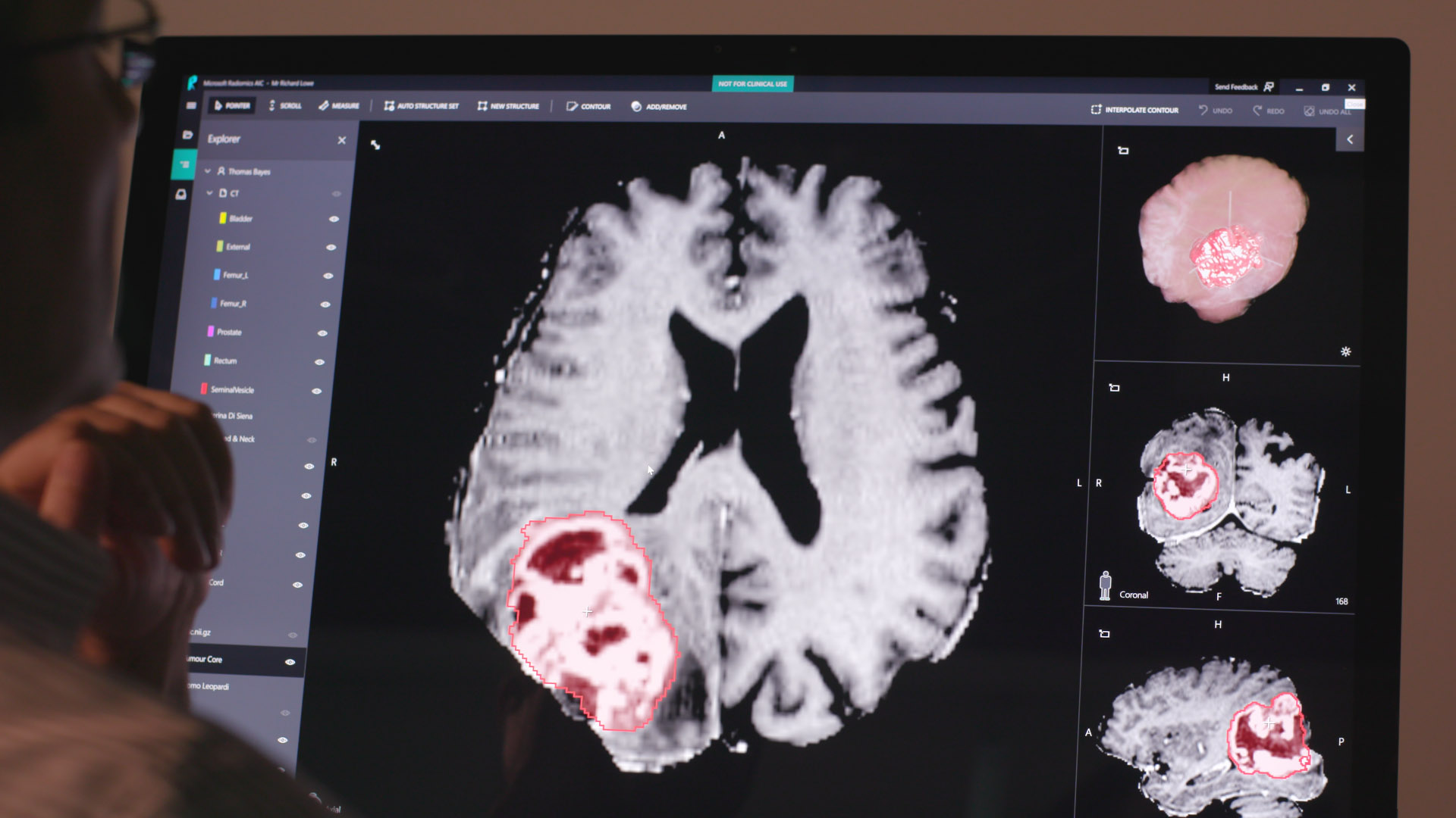 Project InnerEye screenshot on computer screen